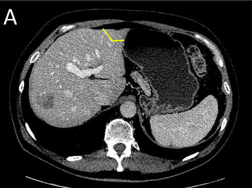 General Surgery - Portal Vein Embolization (PVE)