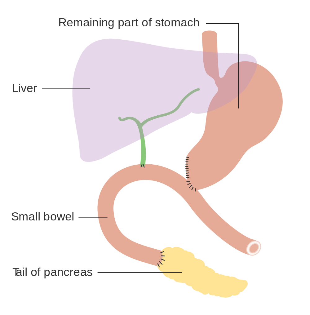 General Surgery Whipple Procedure Pancreaticoduodenectomy