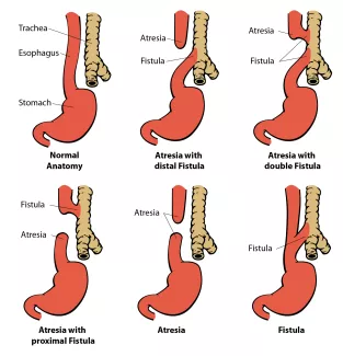 Varients of Esophageal Atresia & Tracheoesophageal Fistula