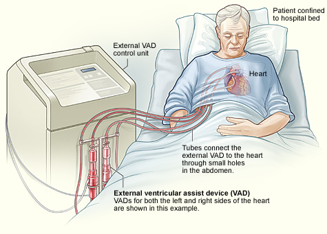 Ventricular Assist Devices (VAD) | General Surgery