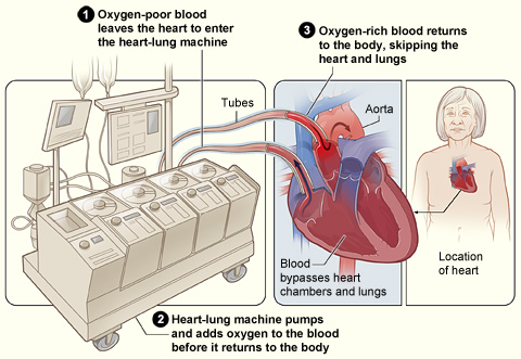 heart_surgery