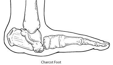 Charcot02